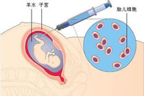 孕妇殒命手术台 羊水栓塞是主因 